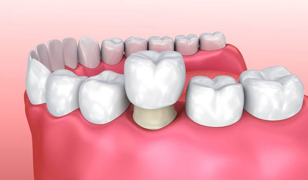 dental-crowns-in-Pitampura