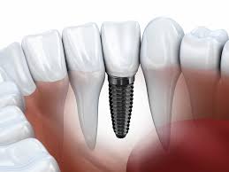 Dental-Implant-in-Saraswati-Vihr-Delhi