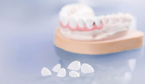 dental veneers in Delhi