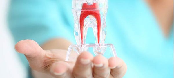 Root Canal Treatments