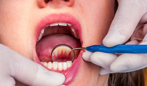 dental-cleaning-in-pitampura