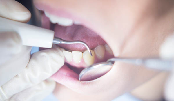 dental-cleaning-in-pitampura