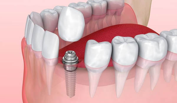 dental-implant-in-pitampura