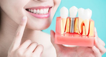 Dental Implants