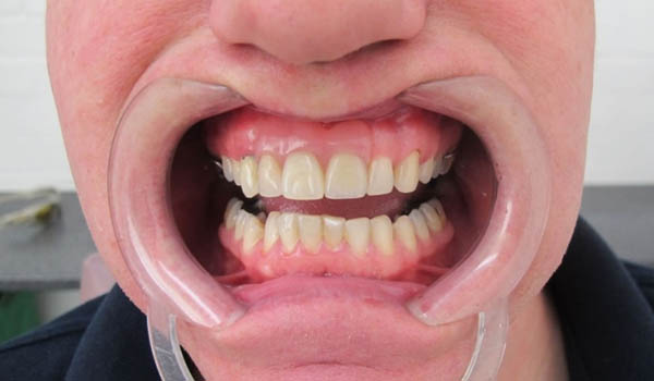 denture-2 denture-2