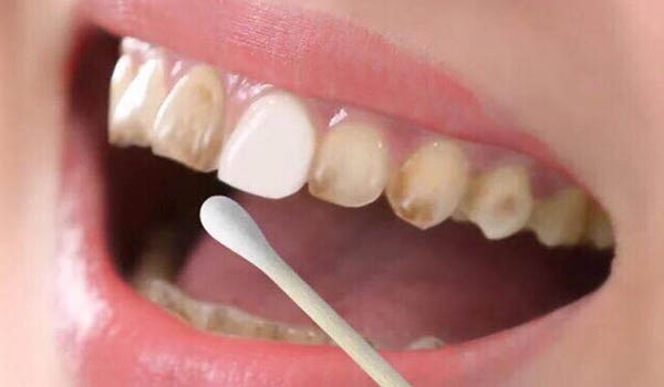 Best Teeth Whitening in Pitampura